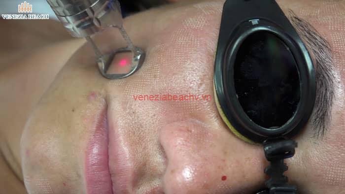 Preventive Measures to Protect your Skin from Laser Damage